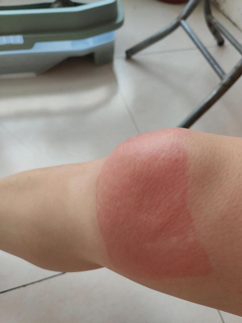 风湿贴膏药后火辣辣的