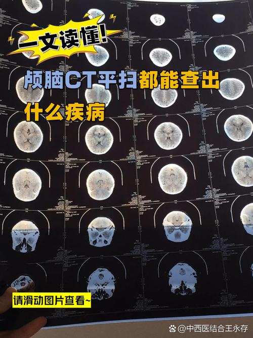 如何看懂脑梗脑ct图