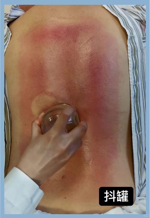 火疗治疗类风湿关节炎