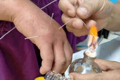 火疗治疗类风湿关节炎