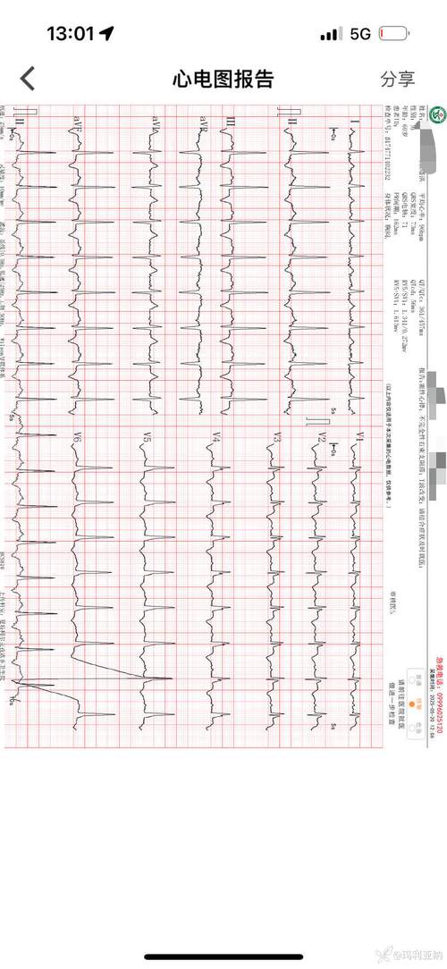 心电图检查出脑梗心梗