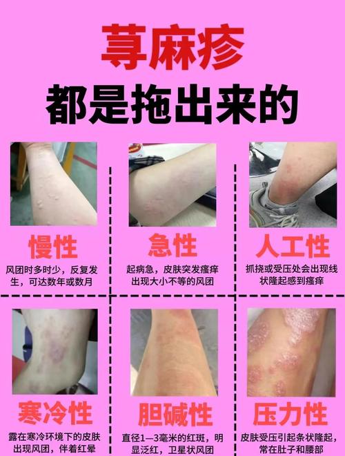 风湿性荨麻疹能自愈吗