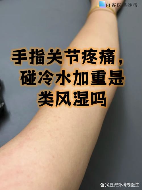 风湿病人冷是怎么回事