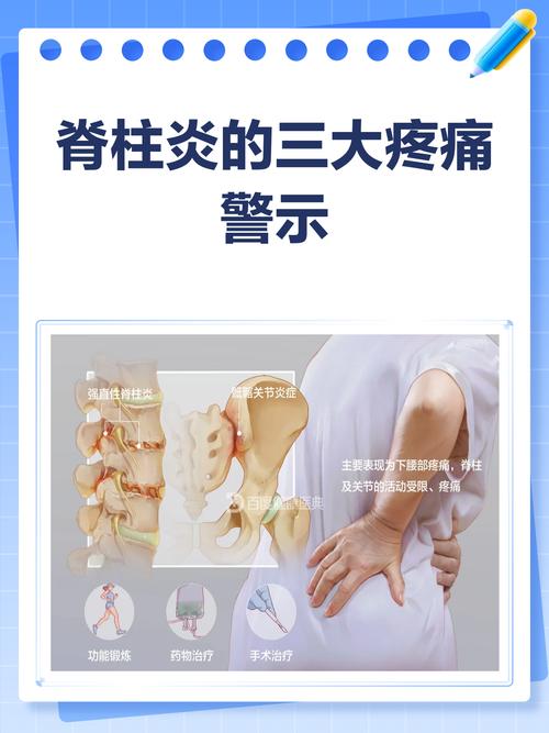 风湿性脊椎炎怎么治疗