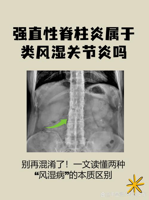 强制性脊柱炎和类风湿