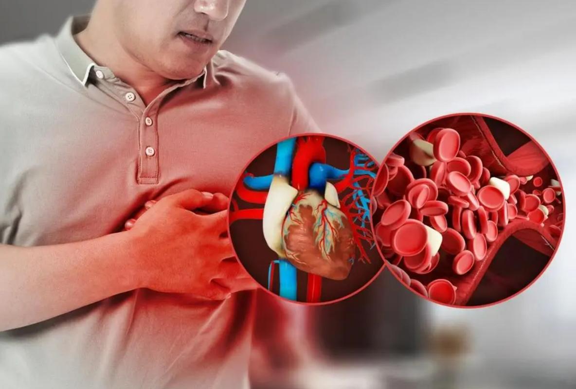 心脏夹层引发心梗脑梗