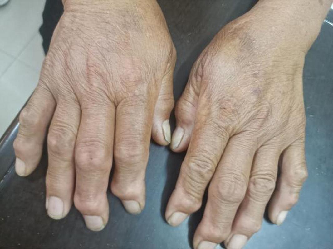 类风湿性关节类的症状