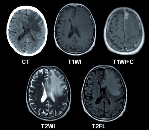 脑磁共振正常不会脑梗