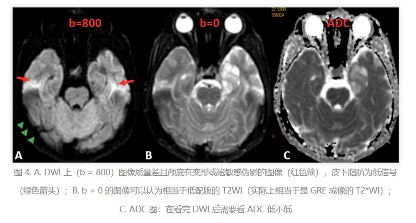 脑磁共振正常不会脑梗