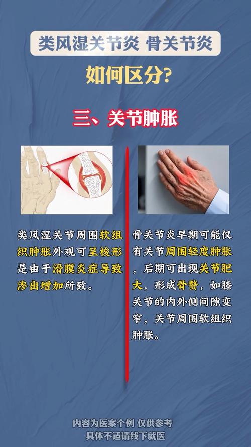 抗o高腿疼是风湿病吗