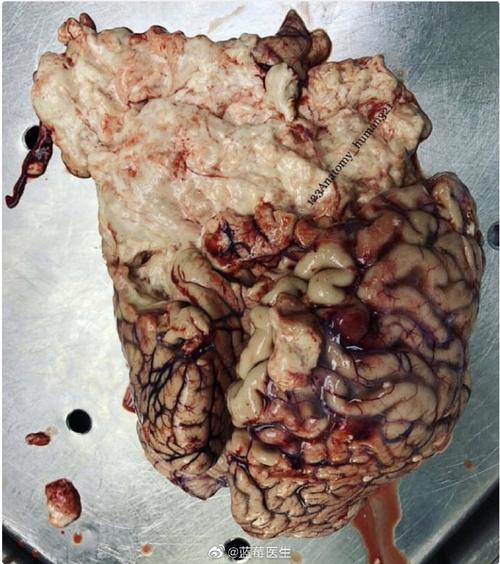 脑梗如果梗完了回这样