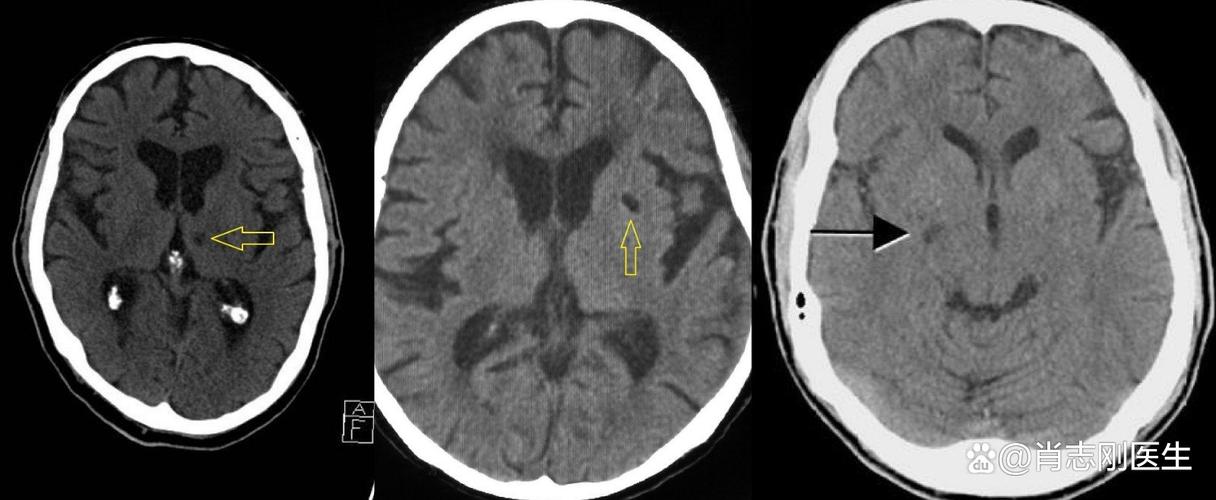 脑内多发缺血 脑梗灶