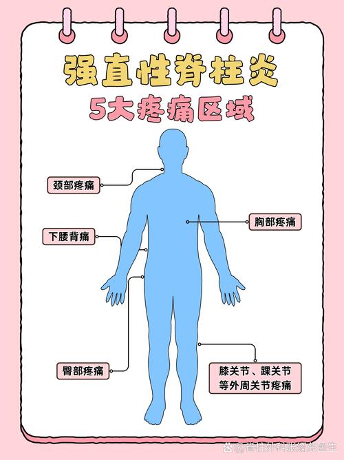 强制性脊柱炎算风湿吗