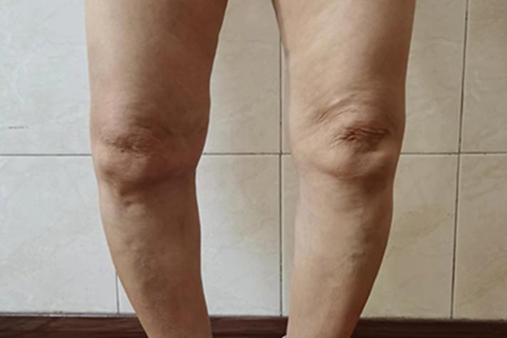 一般风湿病的症状图片