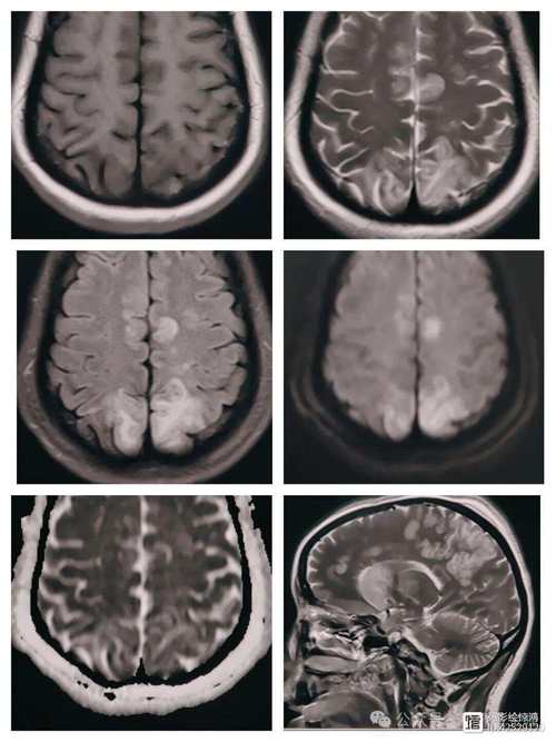脑梗脑白质是什么症状