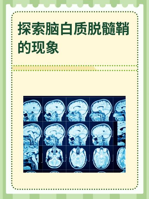 多发脑梗脑白质脱髓鞘