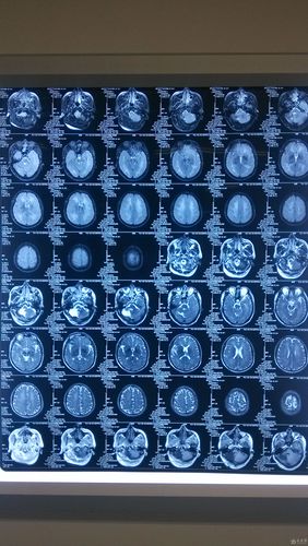 多发脑梗脑白质脱髓鞘