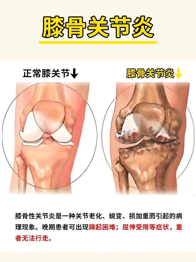膝关节炎和风湿的区别