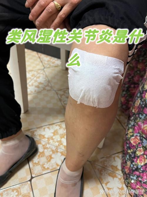 赛尔复得能治风湿病吗