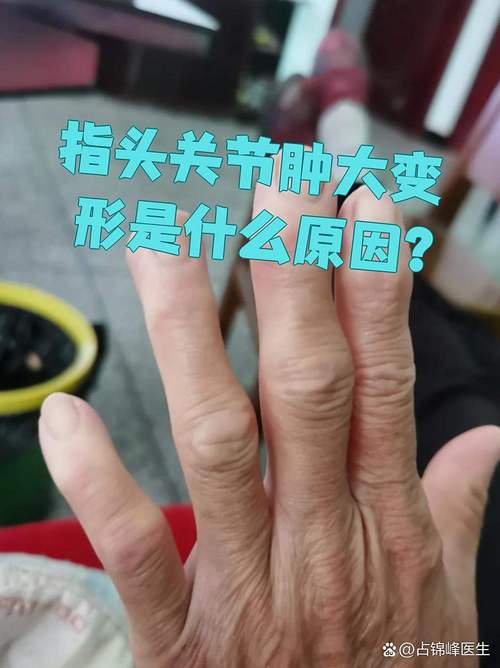 手指头风湿是怎么回事