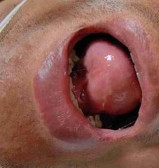 脑梗患者脑堵舌头后缀