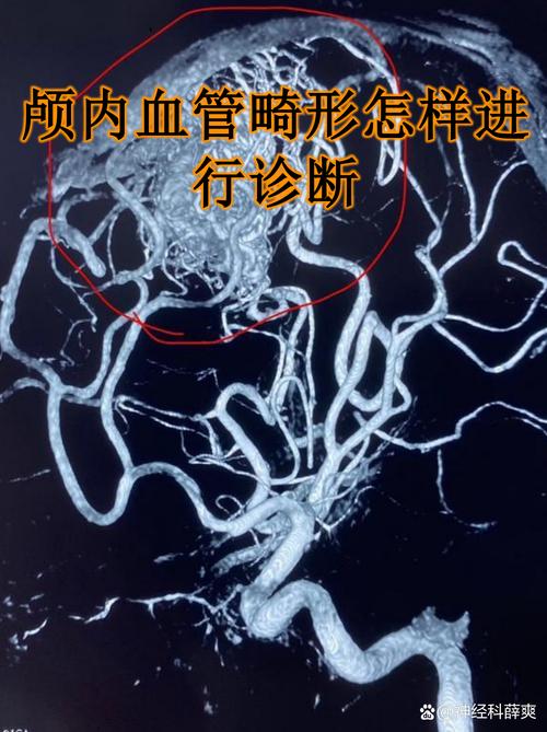 脑梗 心梗可以造影么