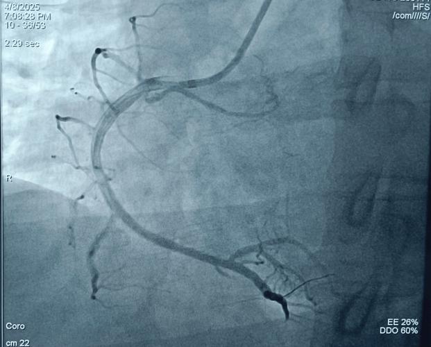 脑梗 心梗可以造影么