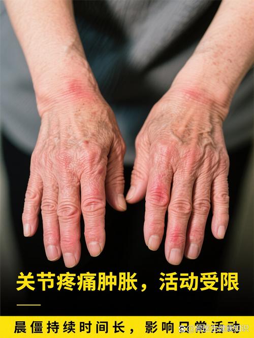 疼会一直伴随类风湿吗