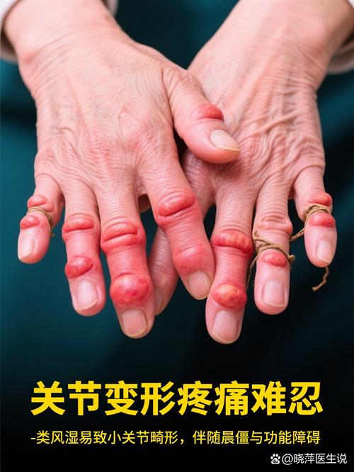 哪家看类风湿关节炎好