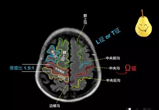 怎样区别脑梗还是脑沟