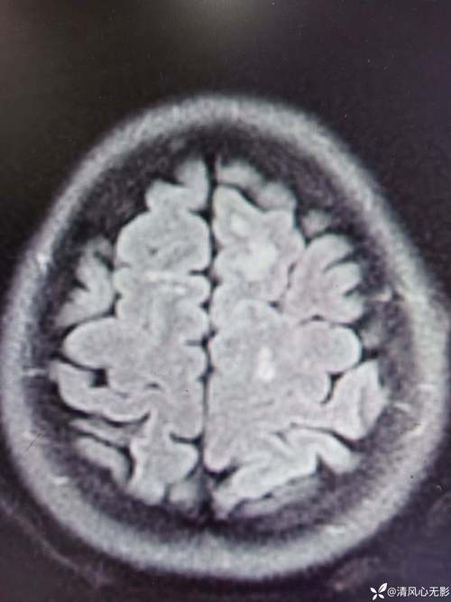 脑内多发缺血灶 脑梗