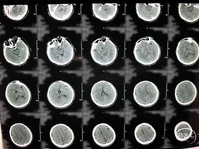 轻度脑梗的脑CT片子