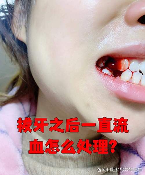 脑梗 拔牙 出血