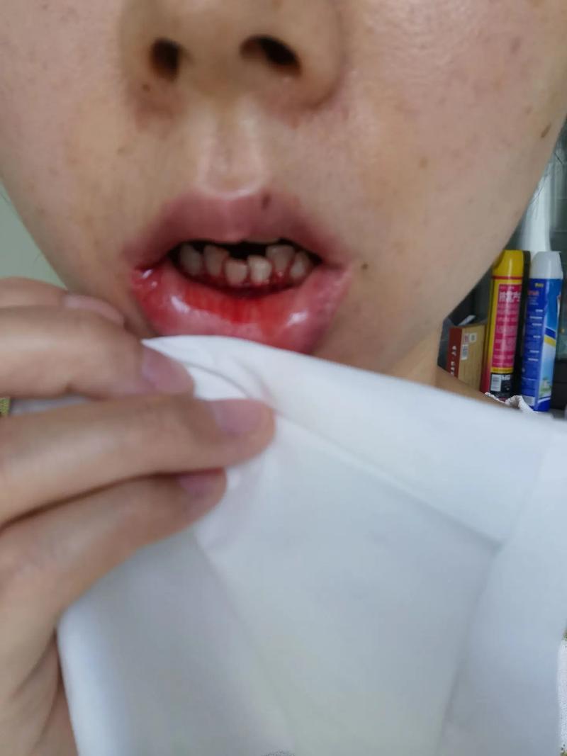 脑梗 拔牙 出血