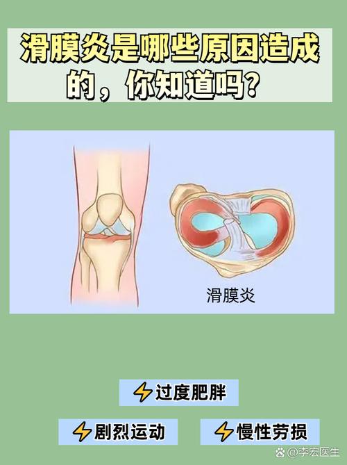 什么是类风湿性滑膜炎