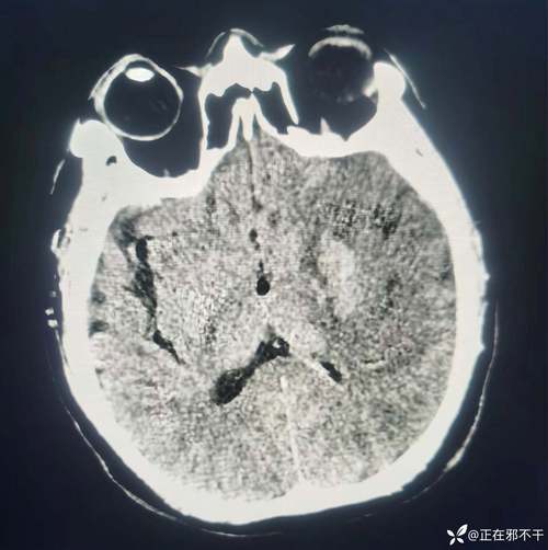 脑梗 脑淤血 脑血栓