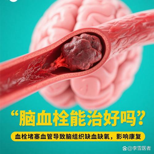 脑梗 脑淤血 脑血栓