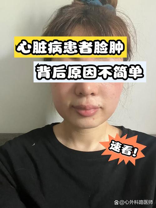 风湿性心脏病症状面容