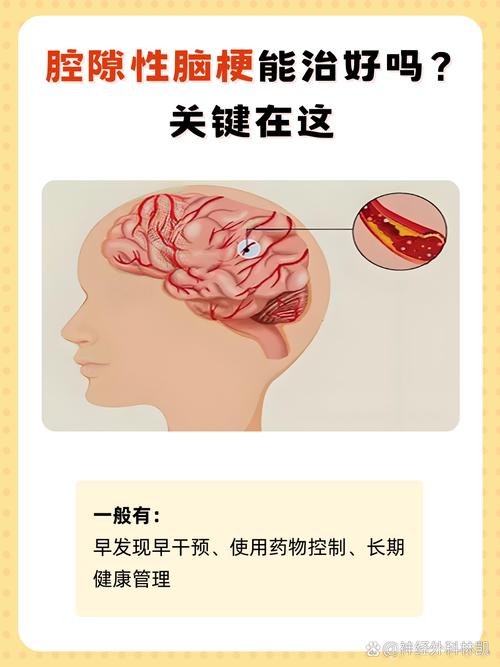 脑梗与腔隙性脑梗区别