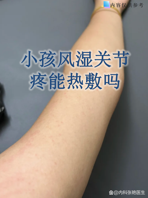 儿童风湿性关节炎原因