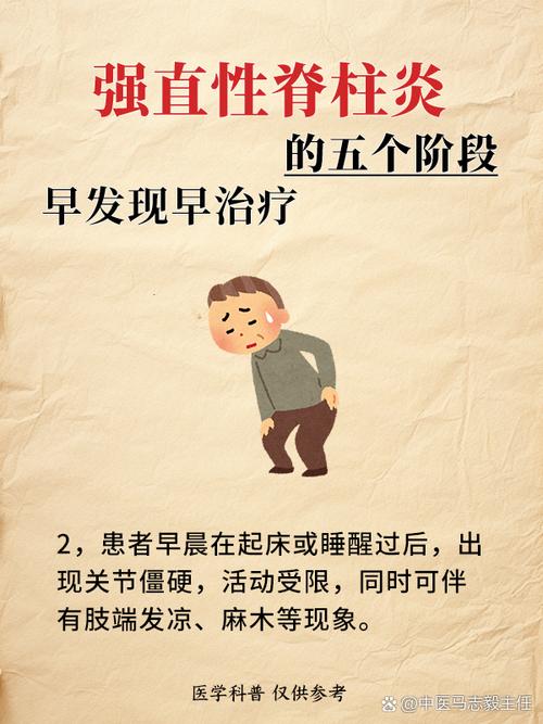 风湿性脊柱炎怎样治疗