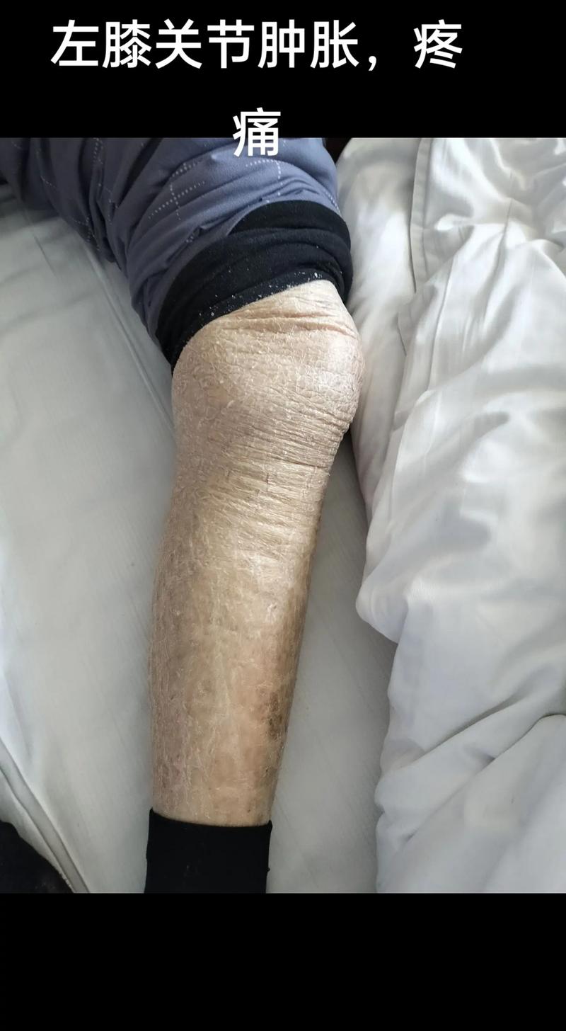 类风湿膝关节炎的治疗