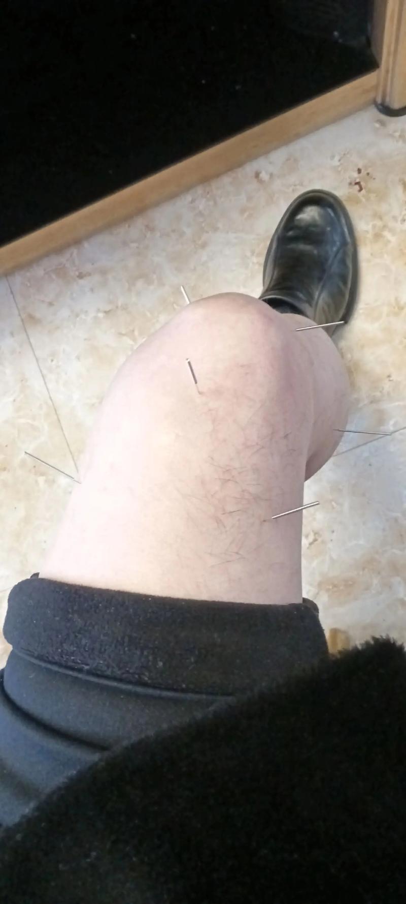 膝盖风湿性关节炎针灸