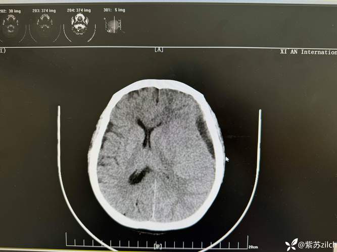 摔跤 脑 淤血 脑梗