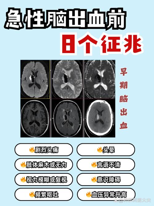 脑梗脑梗出血怎么回事