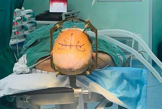 急性脑梗做非脑梗手术