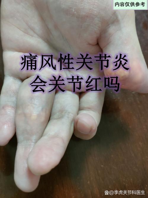 风湿性关节炎晚上疼痛