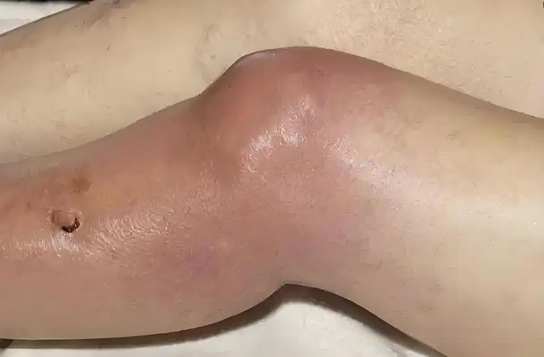 风湿性关节炎晚上疼痛