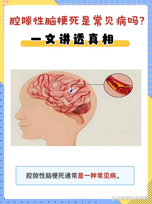 什么是脑梗脑梗是啥病