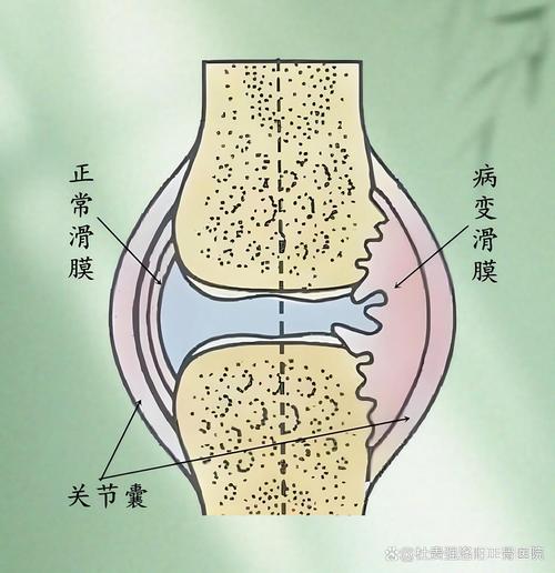 类风湿关节炎好发部位
